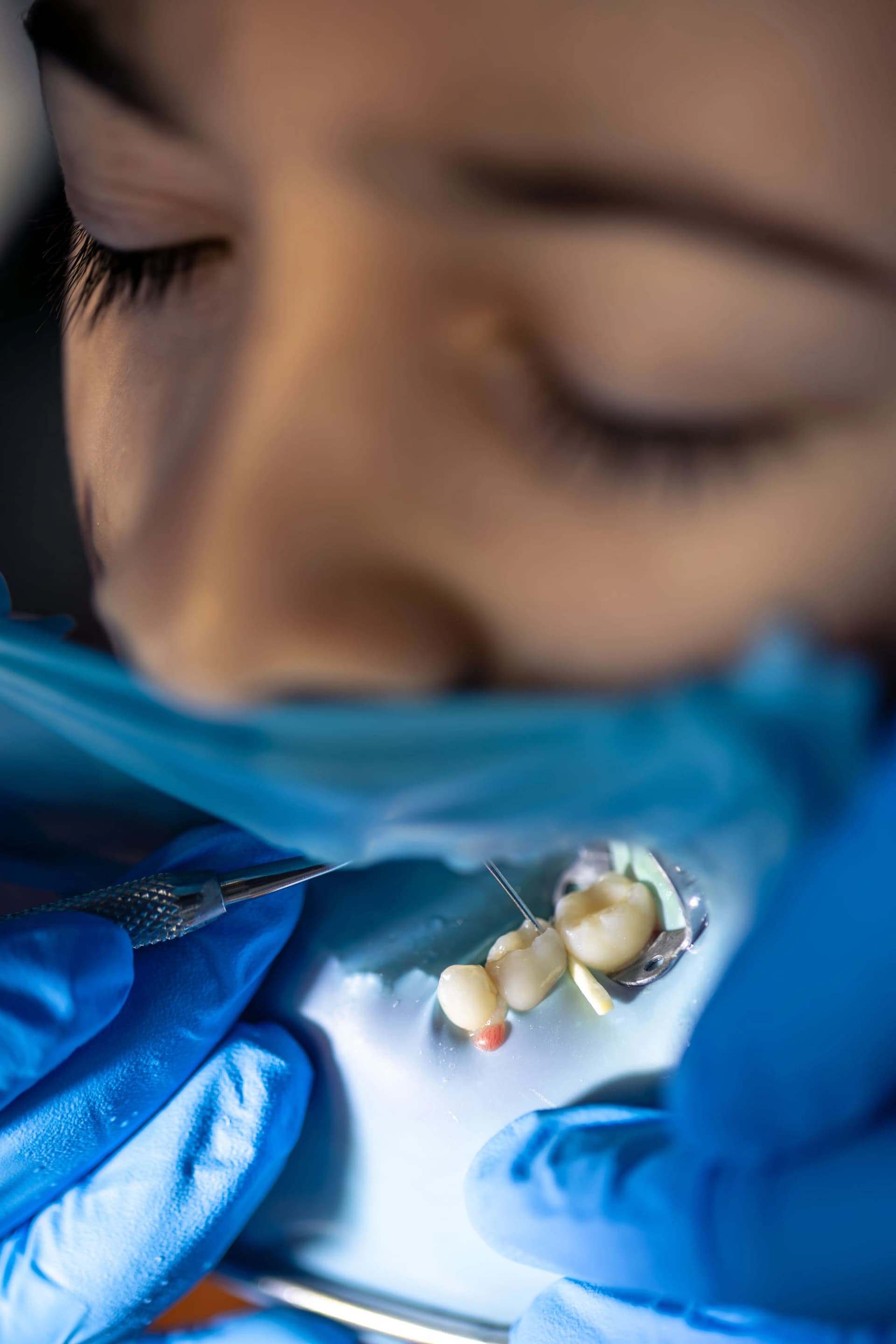 Modern Dental Implants